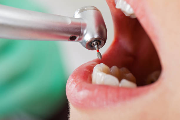 Best Emergency Tooth Extraction in Dickson, TN